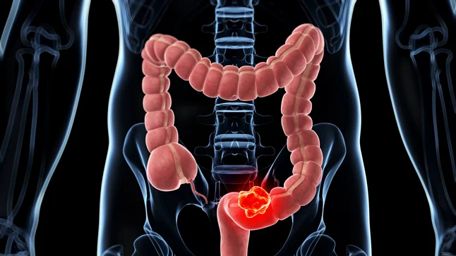 Cáncer Colorrectal: Síntomas de alerta que no debes ignorar